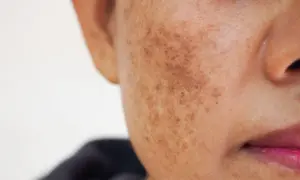 Gros plan sur une joue montrant une tache brune soleil, signe d'une exposition passée au soleil.