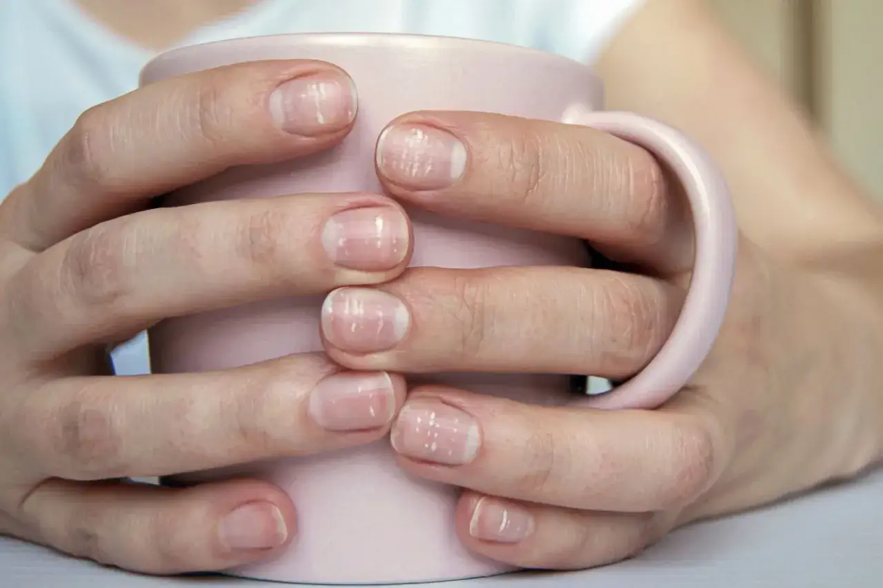 Mains tenant une tasse rose, les ongles pr&eacute;sentent des lignes blanches, un signe d'ongle blanc.