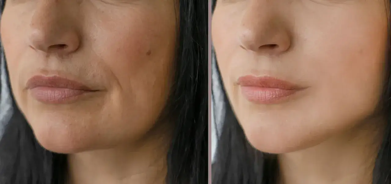 Comparaison avant/apr&egrave;s : le sillon nasog&eacute;nien est moins marqu&eacute;, la peau est plus lisse et le visage semble rajeuni.