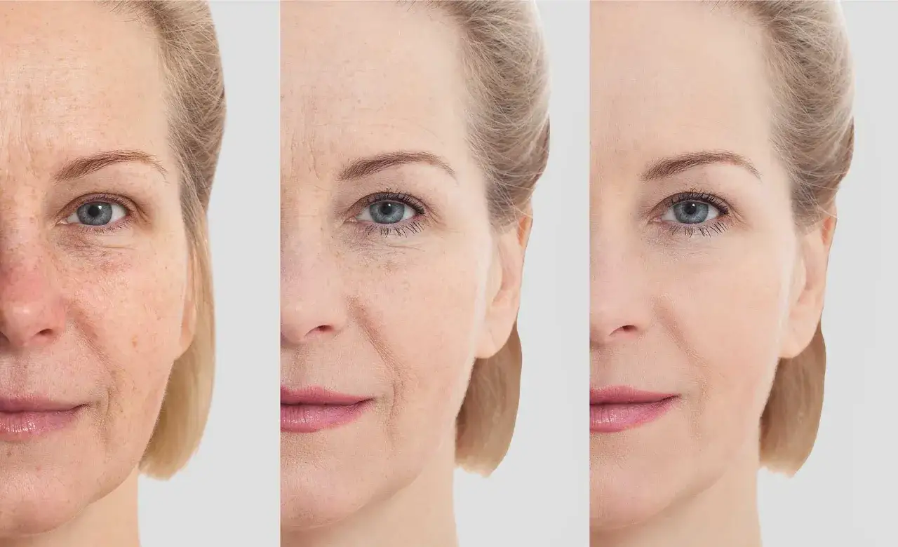 Avant/apr&egrave;s : peau marqu&eacute;e par le temps, puis liss&eacute;e. Avis dermatologue sur l'acide hyaluronique pour un teint rajeuni.