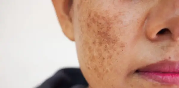 Gros plan sur une joue montrant une tache brune soleil, signe d'une exposition passée au soleil.