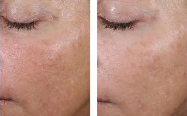 Comparaison avant/après : peau avec rougeurs et irrégularités, puis peau plus lisse et uniforme, peut-être grâce au retinol ou acide hyaluronique.